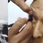 400 barineses con cataratas son evaluados para jornada de cirugía